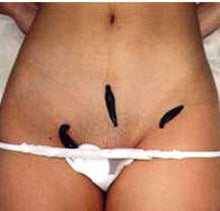 Vaginal Leech THERAPY to Cures Infertility & Helps you Get Pregnant