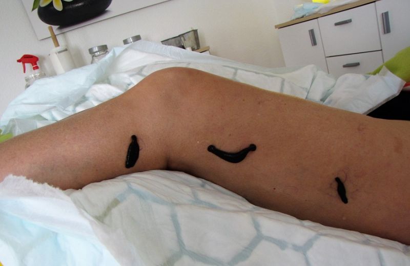 Leech therapy: everything explained in detail