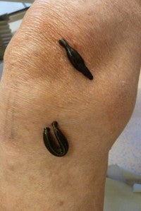 Leech therapy for osteoarthritis