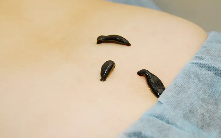 What is Leech therapy? (Also known as hirudotherapy)