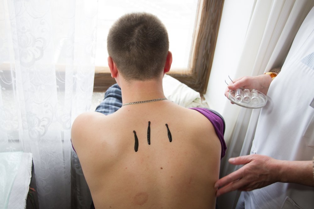 Leech Therapy for Lower Back Pain (Video)