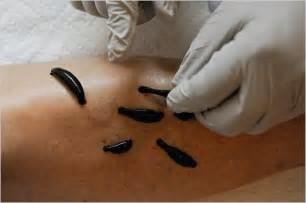What is Leech Therapy ?
