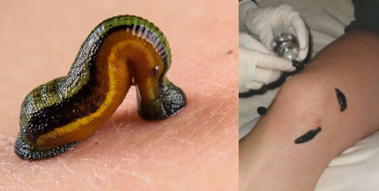 Leech therapy for varicose veins, joint pain and tinnitus