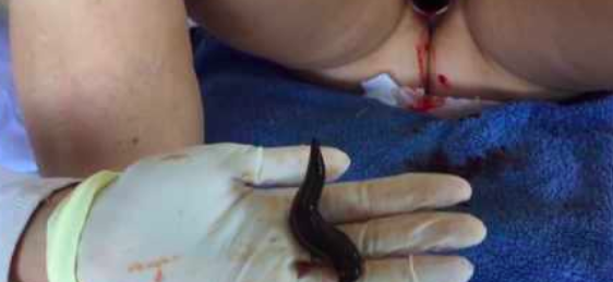 Leech Therapy on Female Patient with Tsetsi